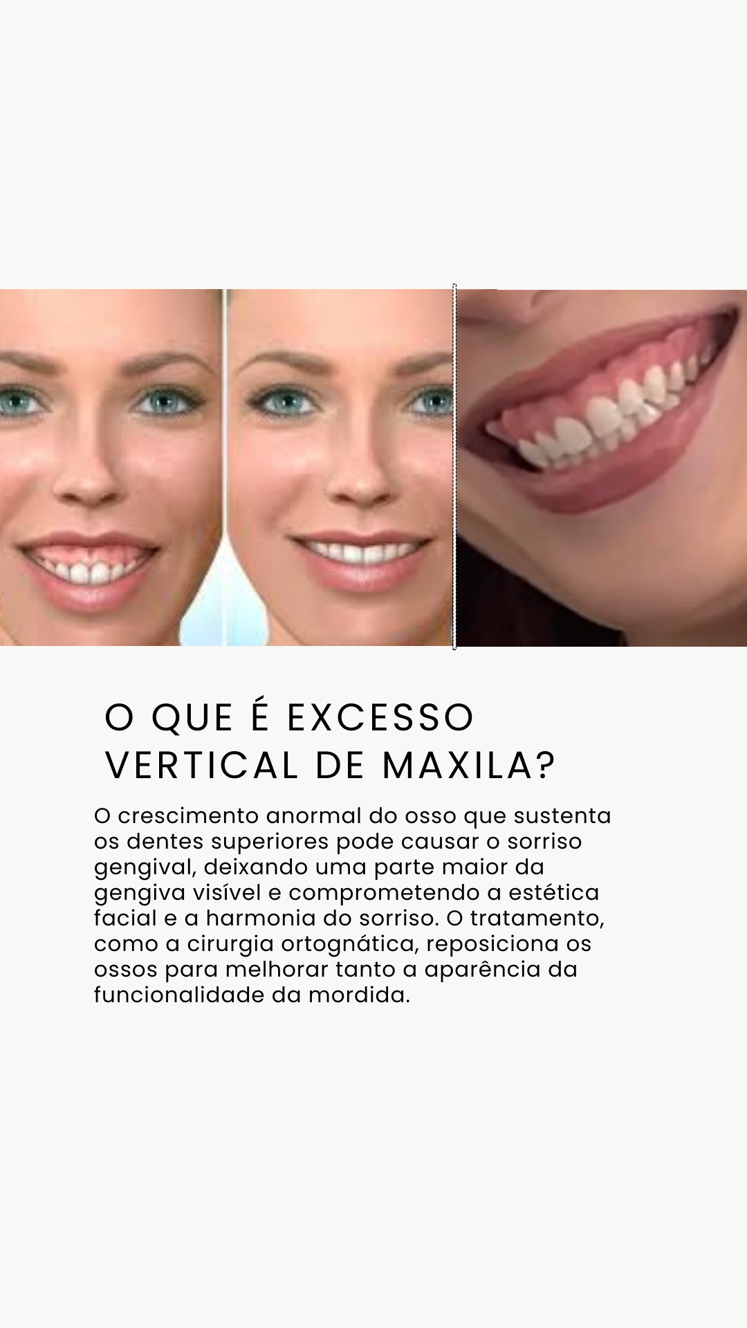 Excesso Vertical Maxila