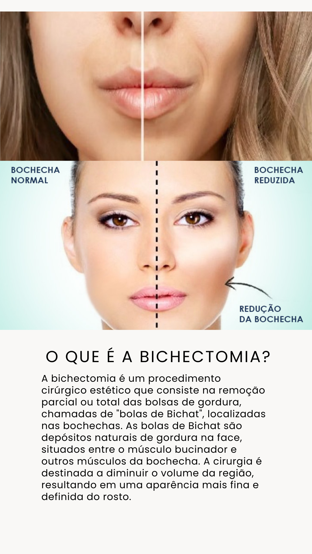 Bichectomia