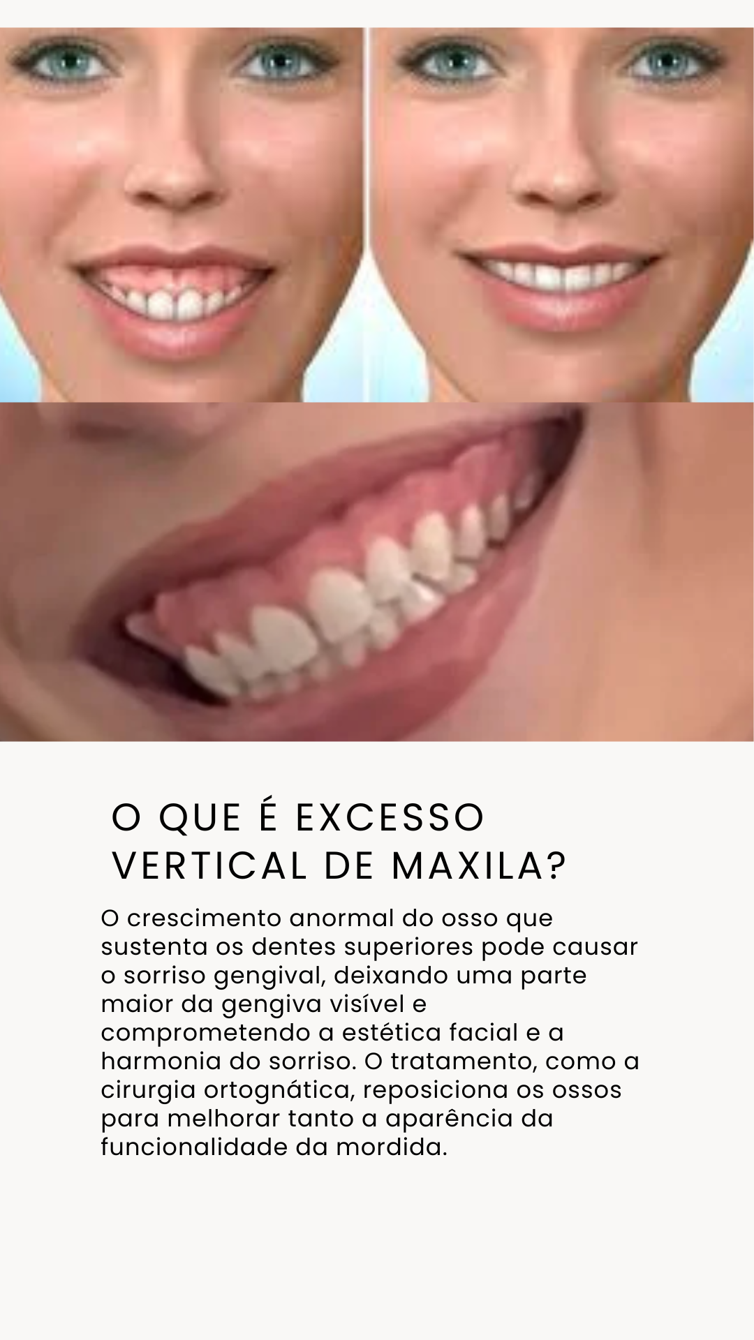 Excesso Vertical Maxila