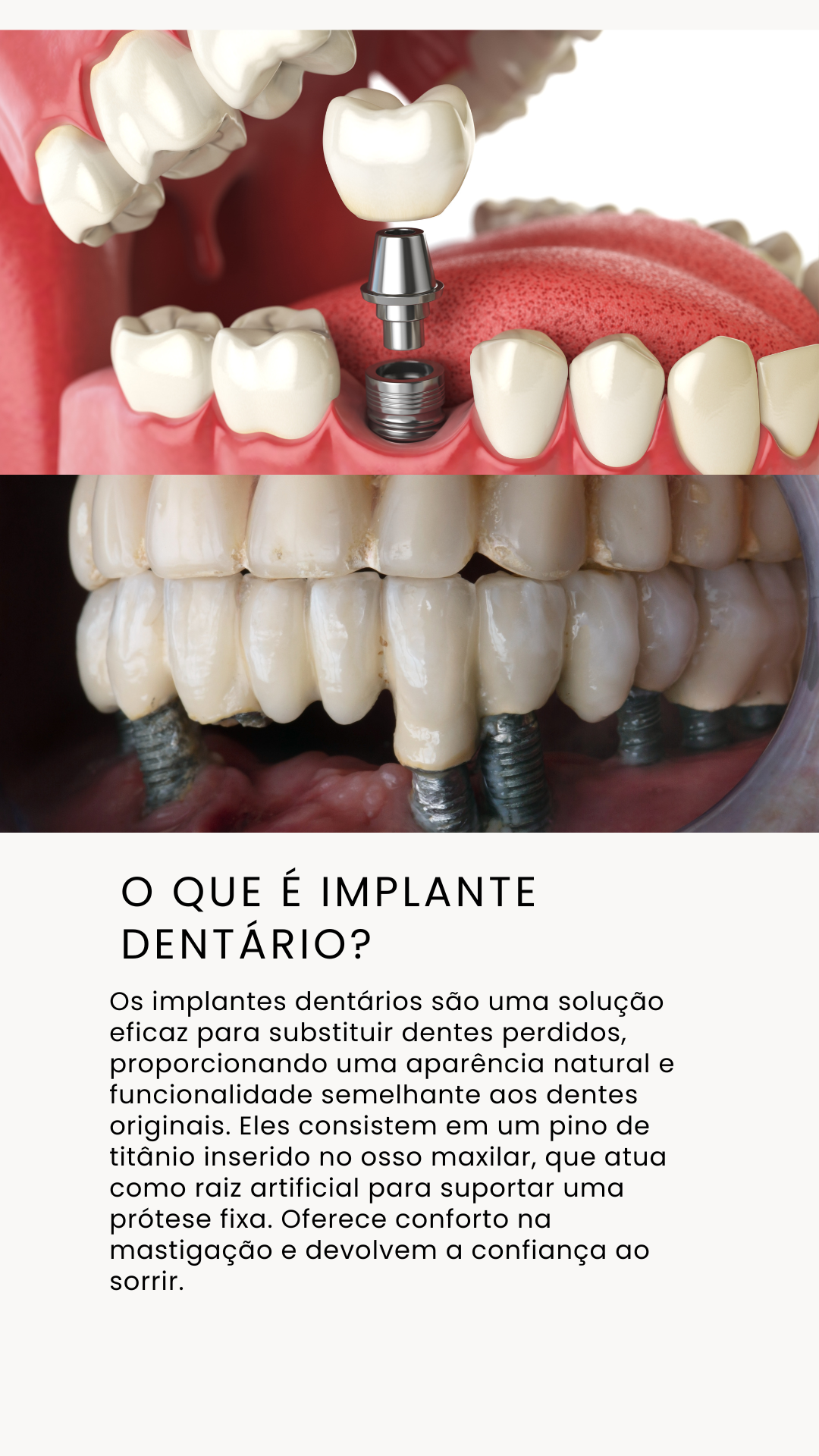 Implantes Dentários