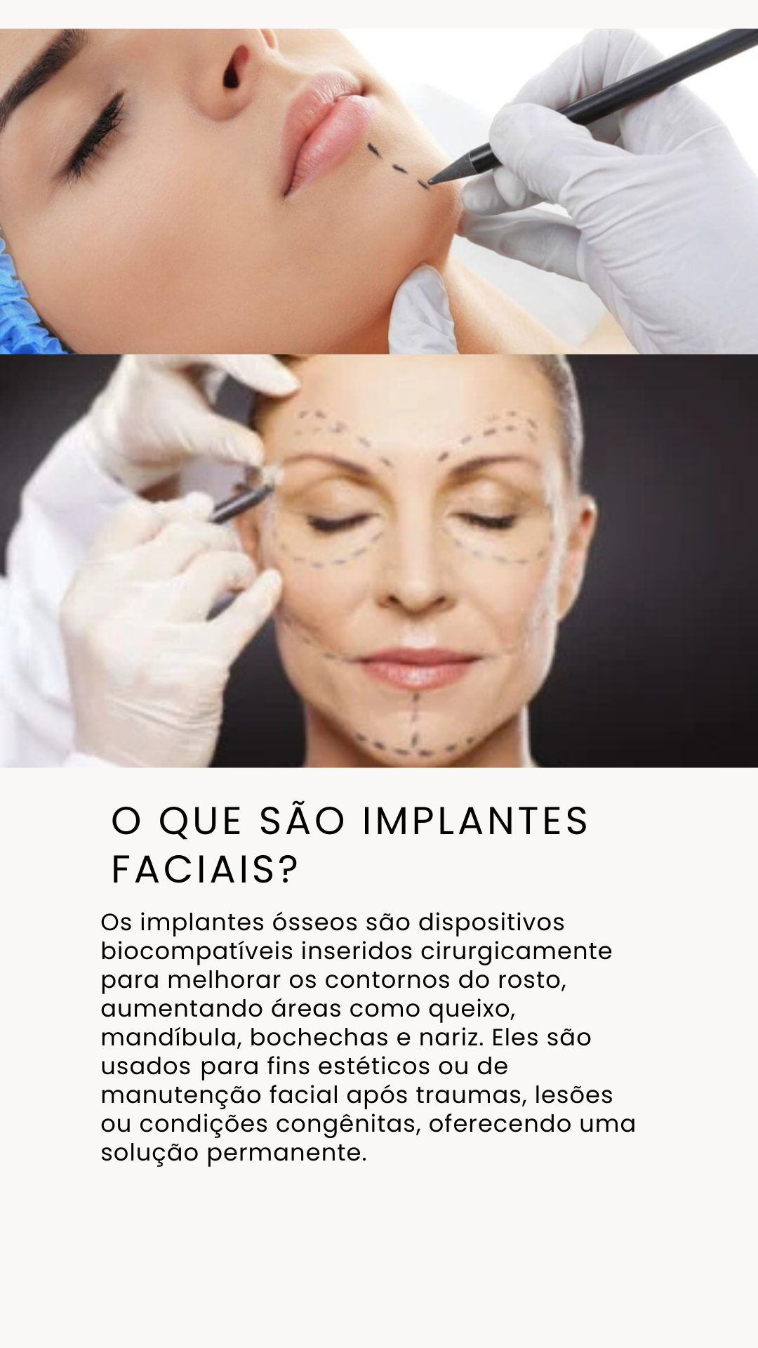 Implantes Faciais