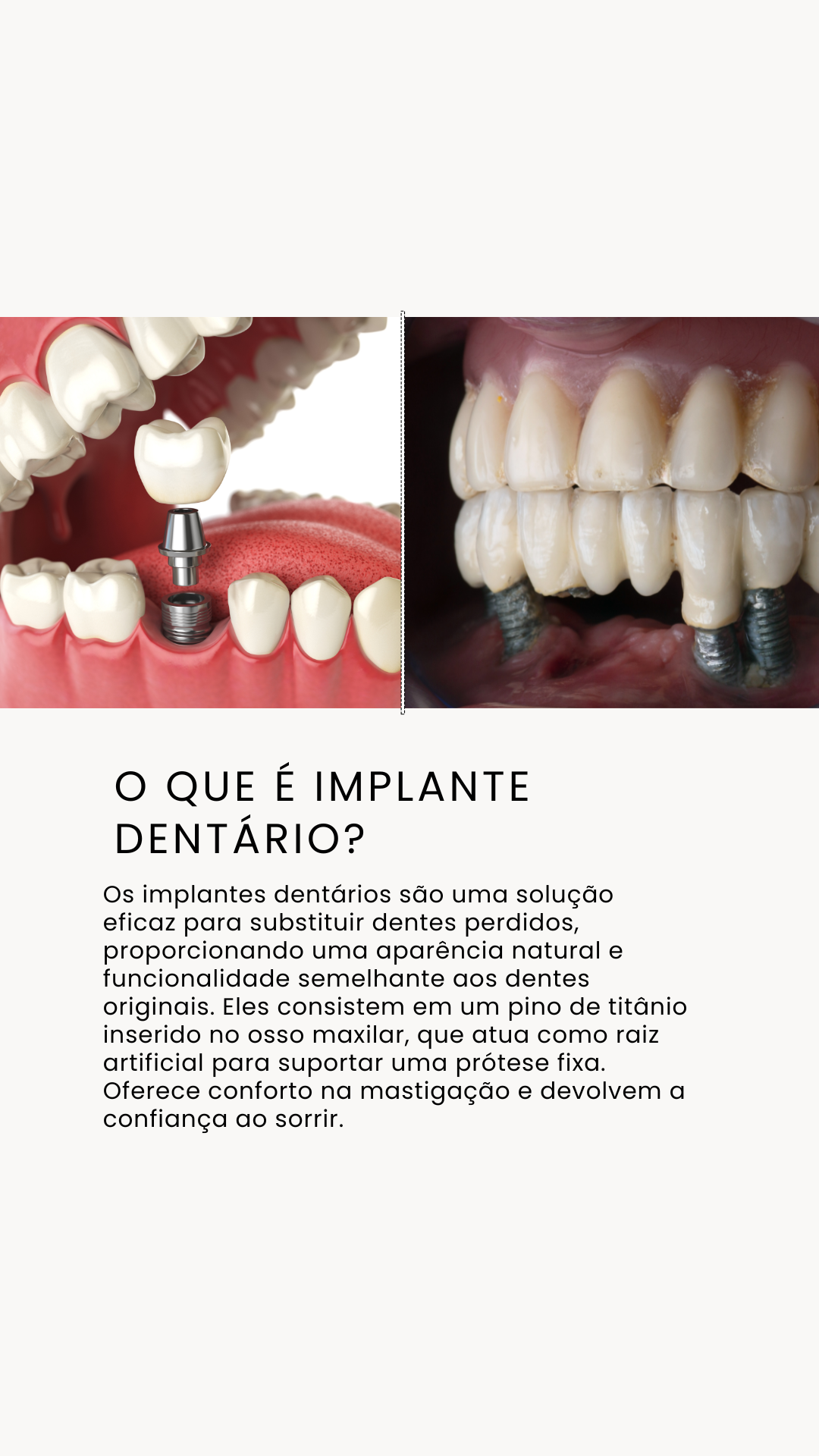 Implantes Dentários