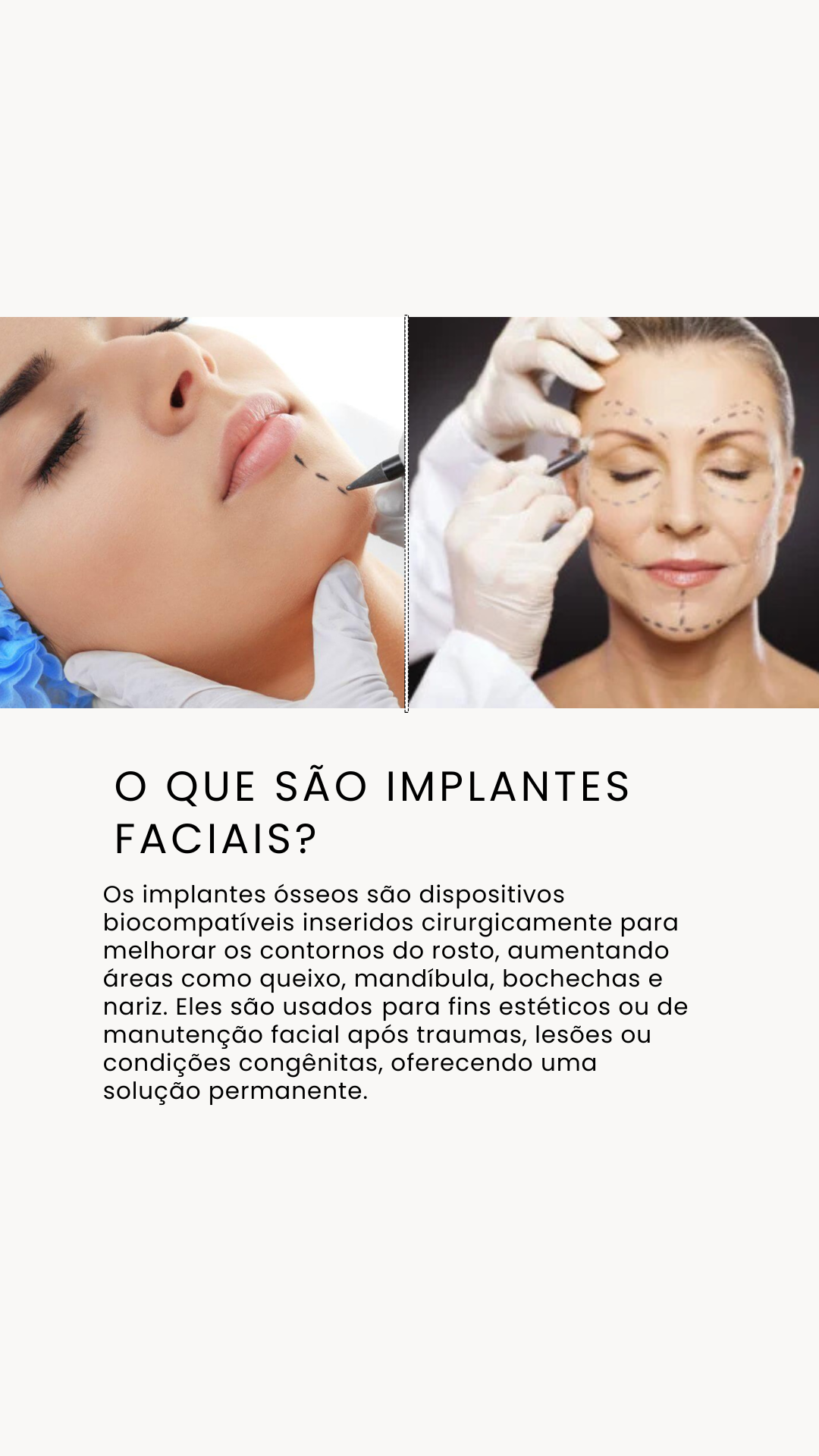 Implantes Faciais